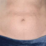 After Emsculpt Neo Treatment