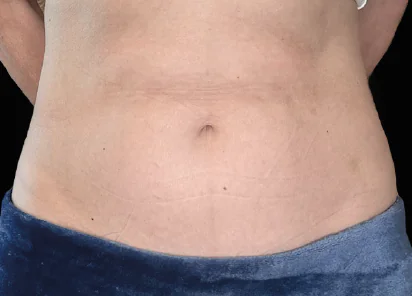 Emsculpt Neo Before and After - Case emsculpt, Image 2 - Male, age 35 – 44 - Meridian, ID - The Karlfeldt Center for Aesthetics & Wellness