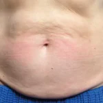 Before Emsculpt Neo Treatment