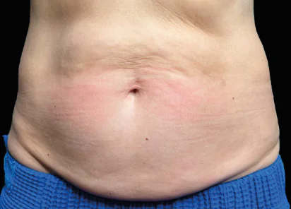 Emsculpt Neo Before and After - Case emsculpt, Image 1 - Male, age 35 – 44 - Meridian, ID - The Karlfeldt Center for Aesthetics & Wellness