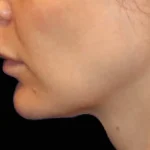 After Emface Treatment