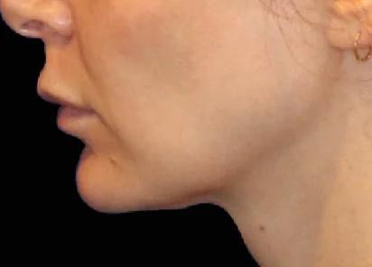 Emface Before and After - Case -1, Image 2 - Female, age 35 – 44 - Meridian, ID - The Karlfeldt Center for Aesthetics & Wellness