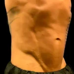 After Emsculpt Neo Treatment