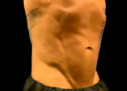 Emsculpt Neo Before and After - Case 2, Image 2 - Male, age 25 – 34 - Meridian, ID - The Karlfeldt Center for Aesthetics & Wellness