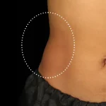 After Emsculpt Neo Treatment