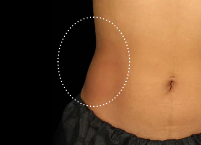 Emsculpt Neo Before & Afters | The Karlfeldt Center for Aesthetics & Wellness