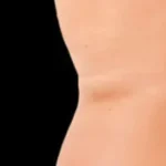 After Exion Body Treatment