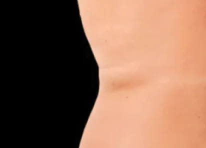 Exion Body Before & Afters | The Karlfeldt Center for Aesthetics & Wellness