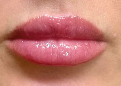 Exion Face Before and After - Case 2, Image 2 - Female, age 25 – 34 - Meridian, ID - The Karlfeldt Center for Aesthetics & Wellness