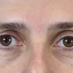 After Exion Face