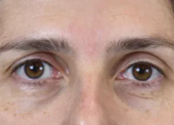 Exion Face Before & Afters | The Karlfeldt Center for Aesthetics & Wellness