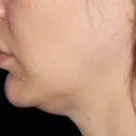 Before Emface Treatment