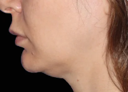 Emface Before and After - Case -1, Image 1 - Female, age 35 – 44 - Meridian, ID - The Karlfeldt Center for Aesthetics & Wellness
