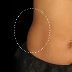 Before Emsculpt Neo Treatment