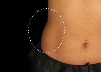 Emsculpt Neo Before & Afters | The Karlfeldt Center for Aesthetics & Wellness