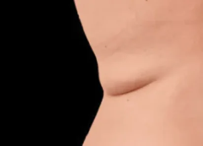 Exion Body Before & Afters | The Karlfeldt Center for Aesthetics & Wellness