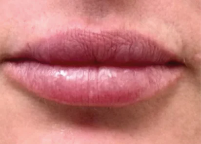 Exion Face Before and After - Case 2, Image 1 - Female, age 25 – 34 - Meridian, ID - The Karlfeldt Center for Aesthetics & Wellness