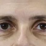 Before Exion Face