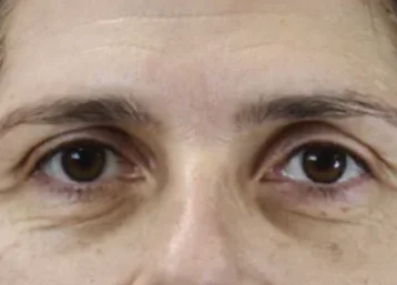 Exion Face Before & Afters | The Karlfeldt Center for Aesthetics & Wellness