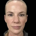 After Emface Treatment