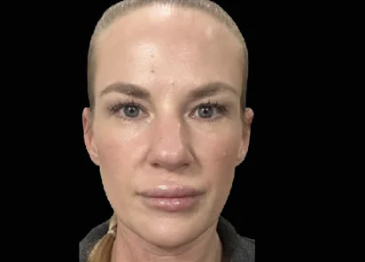 Emface Before and After - Case 2, Image 2 - Female, age 35 – 44 - Meridian, ID - The Karlfeldt Center for Aesthetics & Wellness