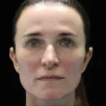 After Emface Treatment