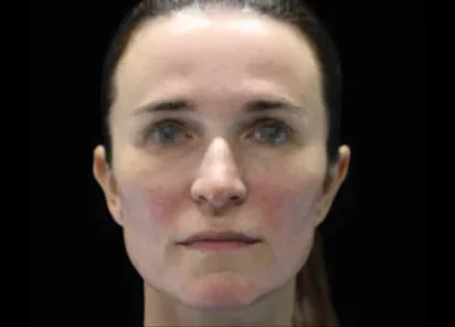 Emface Before & Afters | The Karlfeldt Center for Aesthetics & Wellness