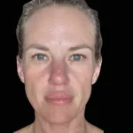Before Emface Treatment