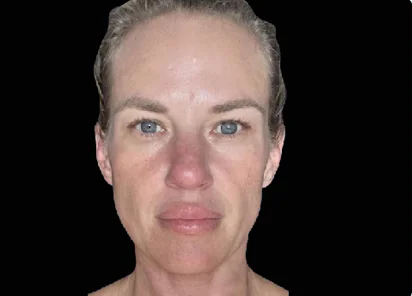 Emface Before and After - Case 2, Image 1 - Female, age 35 – 44 - Meridian, ID - The Karlfeldt Center for Aesthetics & Wellness