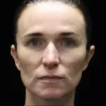 Before Emface Treatment