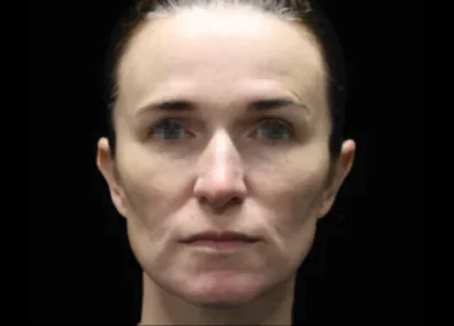 Emface Before & Afters | The Karlfeldt Center for Aesthetics & Wellness