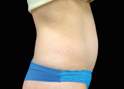 Emsculpt Neo Before and After - Case -1, Image 1 - Female, age 35 – 44 - Meridian, ID - The Karlfeldt Center for Aesthetics & Wellness