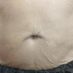 After Exion Body Treatment