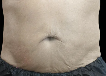Exion Body Before and After - Case -1, Image 2 - Male, age 55 – 64 - Meridian, ID - The Karlfeldt Center for Aesthetics & Wellness
