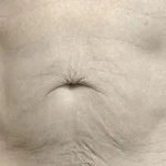 Before Exion Body Treatment