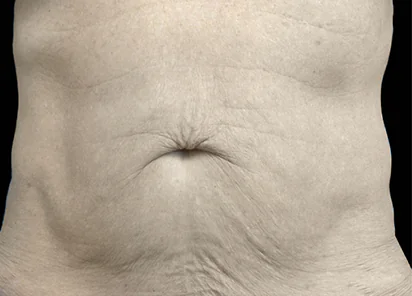 Exion Body Before and After - Case -1, Image 1 - Male, age 55 – 64 - Meridian, ID - The Karlfeldt Center for Aesthetics & Wellness